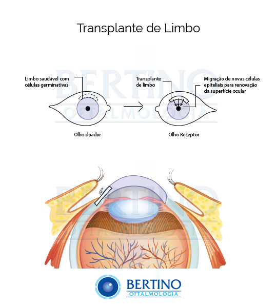 Ilustração: Transplantes de Limbo