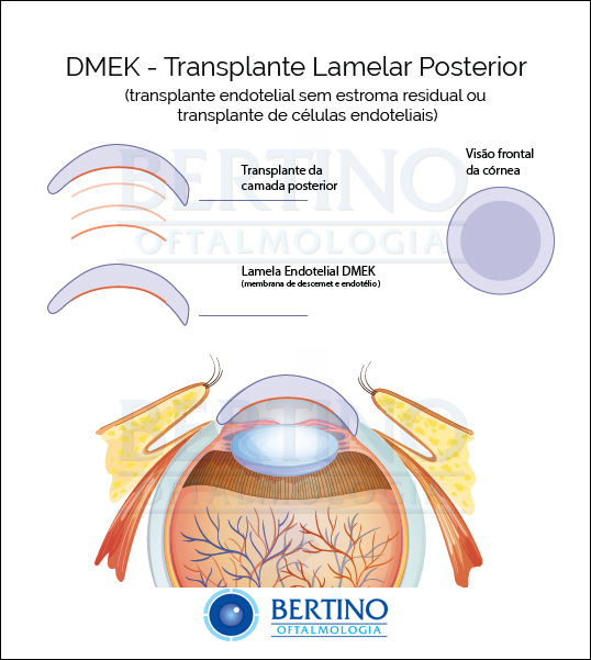 Ilustração: Transplante de Córnea Lamelar Posterior — DMEK e DSAEK