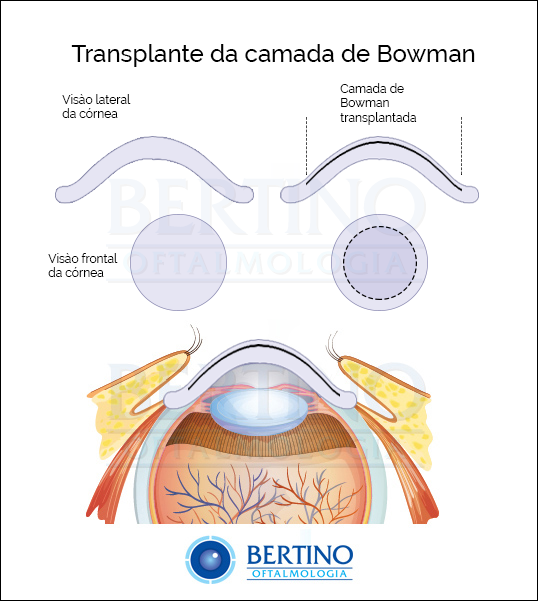 Ilustração: Transplante da Camada de Bowman — Bowman Layer Transplantation
