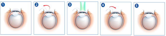 Ilustração: Cirurgia Refrativa Corneana LASIK